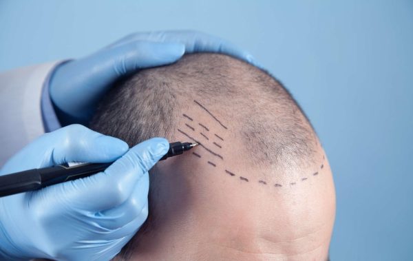 Der ultimative Leitfaden zur Haartransplantation: Was Sie wissen müssen
